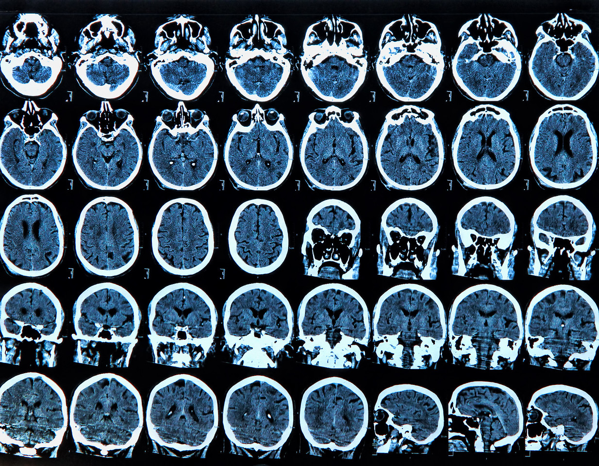 MRI scan of the human brain