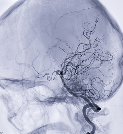 Blood vessels in the brain