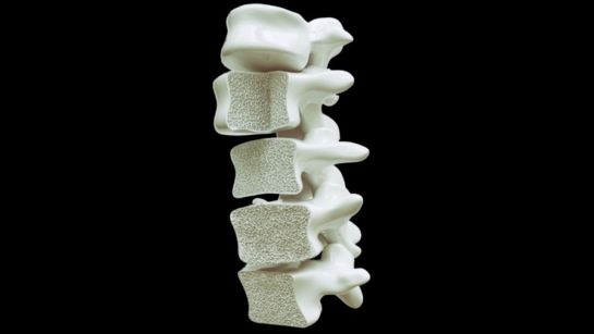 A 3D image of bones with osteoporosis on a black background.